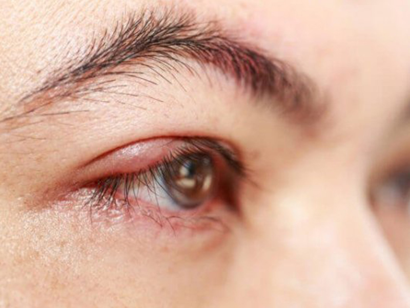 Mí mắt bị sưng sau khi ngủ dậy là tình trạng phổ biến nên không ảnh hưởng quá nhiều tới sức khỏe