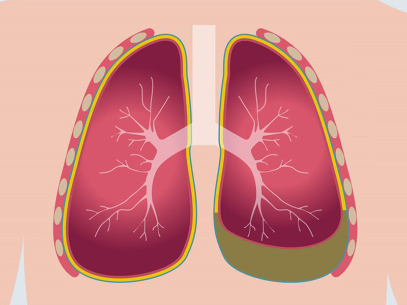 Viêm màng phổi cũng khiến bạn bị đau xương ưc