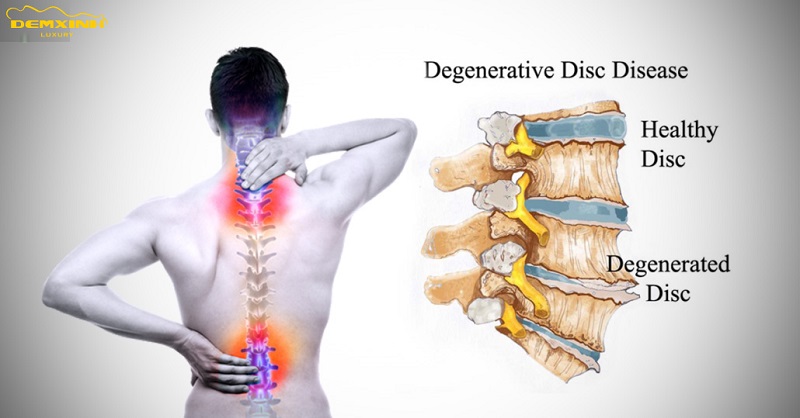 Người bị thoát vị đĩa đệm hoặc các bệnh về xương sống khi nằm đệm mềm cũng có thể gây đau lưng