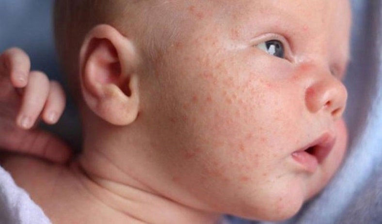 Trẻ sơ sinh hệ miễn dịch yếu khiến trẻ dễ bị dị ứng